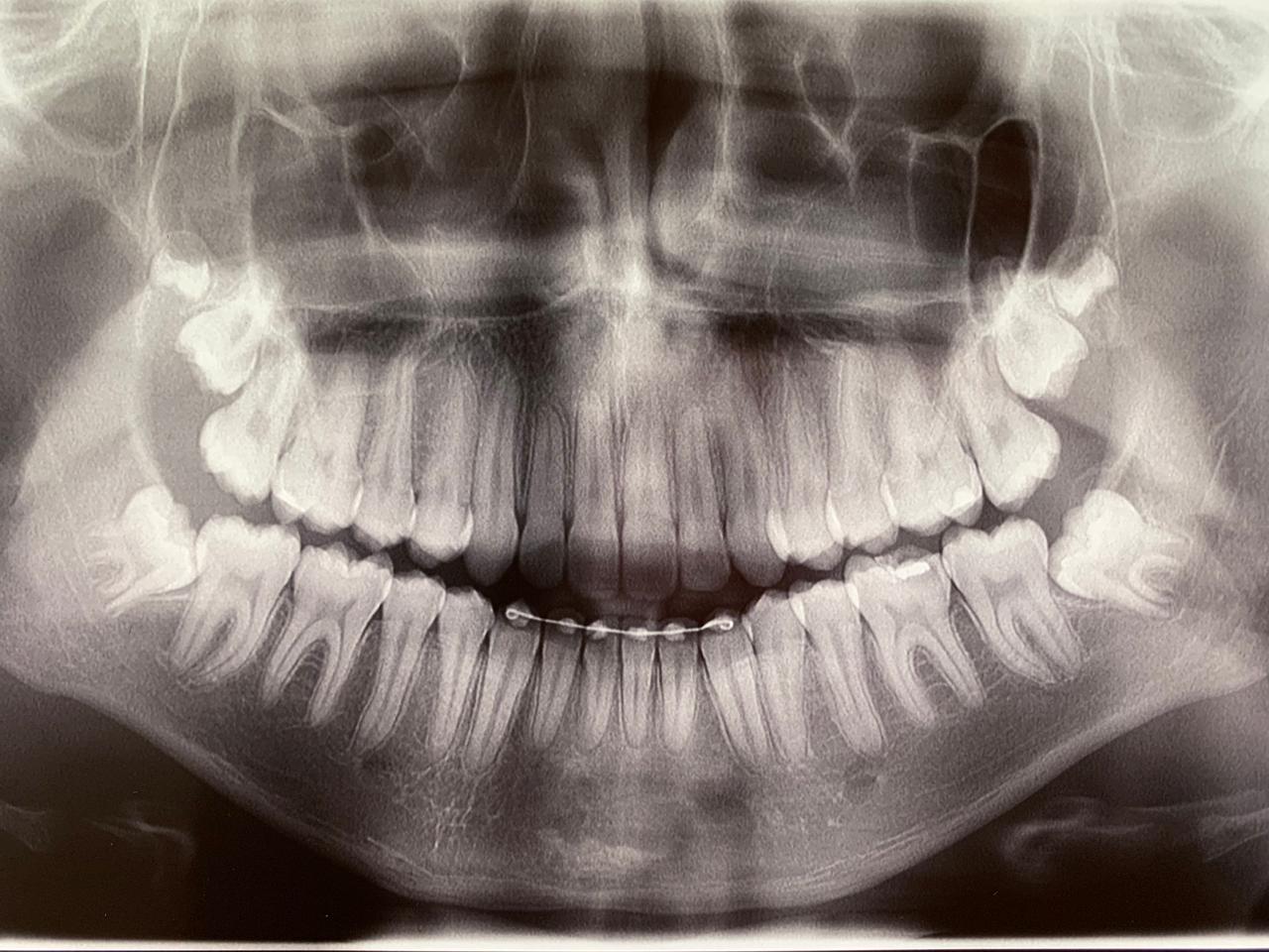 Radiografia dos dentes